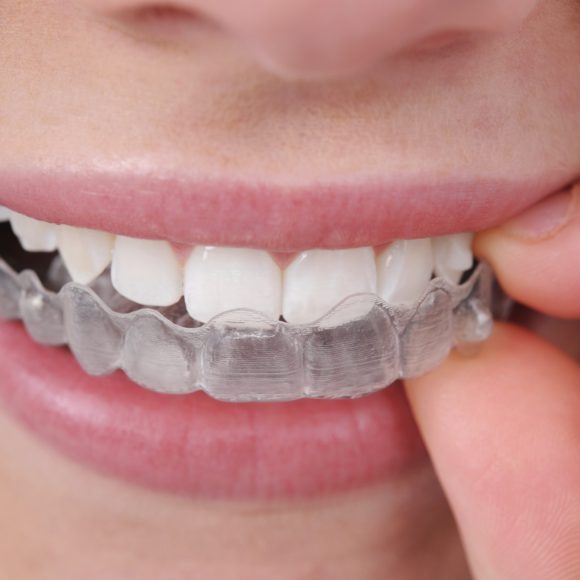 Aparat Invisalign