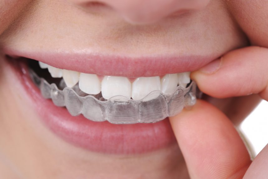 Aparat Invisalign